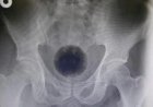 Homem passa por cirurgia para tirar bola de 7cm do ânus