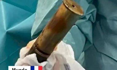 HOMEM CHEGA A HOSPITAL COM BOMBA DA Iª GUERRA MUNDIAL DENTRO DO ÂNUS
