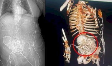 'Bebê de pedra': idosa de 81 anos descobre feto calcificado que carregou por mais de 5 décadas