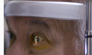 CIRURGIA MAL SUCEDIDA 12 pessoas ficam cegas e entram na fila do transplante de córnea após 'mutirão da catarata'