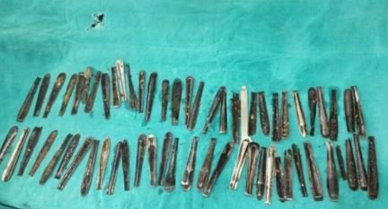 Médico remove 62 colheres de sobremesa de estômago de homem