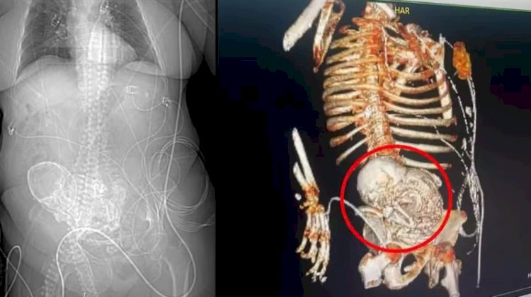 'Bebê de pedra': idosa de 81 anos descobre feto calcificado que carregou por mais de 5 décadas